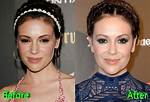 Alyssa Milano Plastic Surgery Before and After