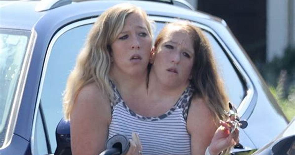 Are the Hensel Twins Still Alive? an in-Depth Look at Their Lives