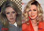 Donna Mills' Plastic Surgery Journey Revealed