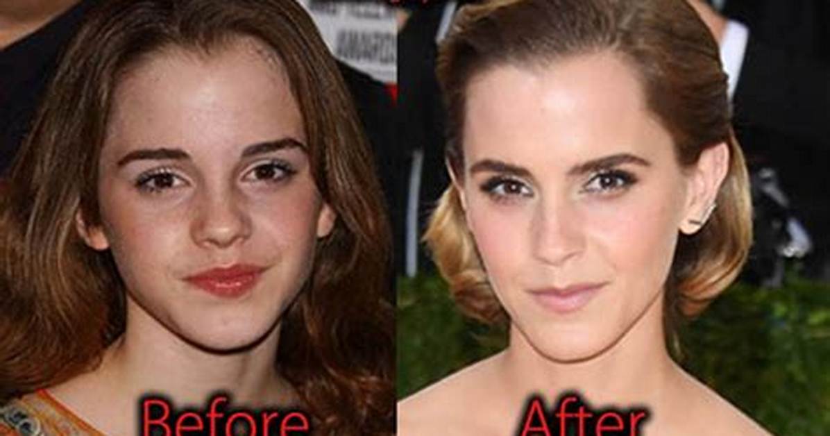 Emma Watson Plastic Surgery Before and After