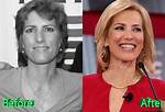 Exploring Laura Ingraham's Plastic Surgery Journey