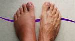 Feet Swelling in the Heat? an Expert Explains Why & How to Stop It| Glamour Uk