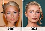 Paris Hilton's Plastic Surgery: Before and After
