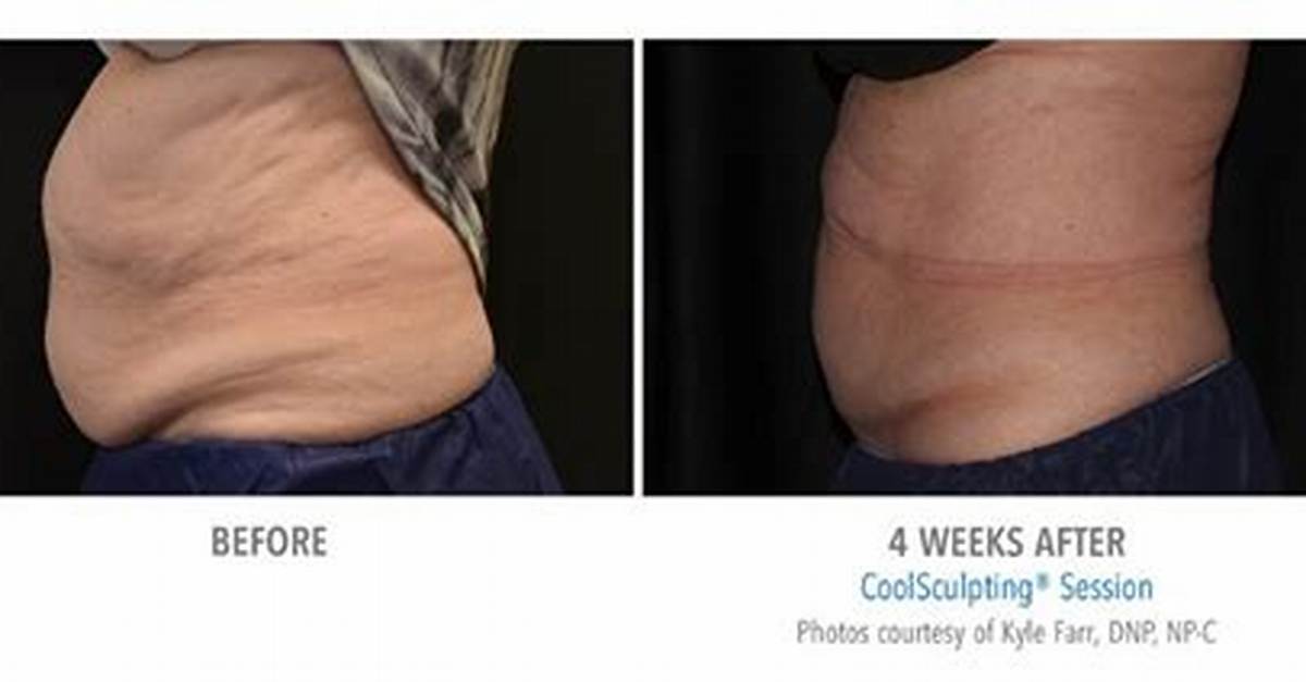 Results Gone Wrong: Cool Sculpting Before and After