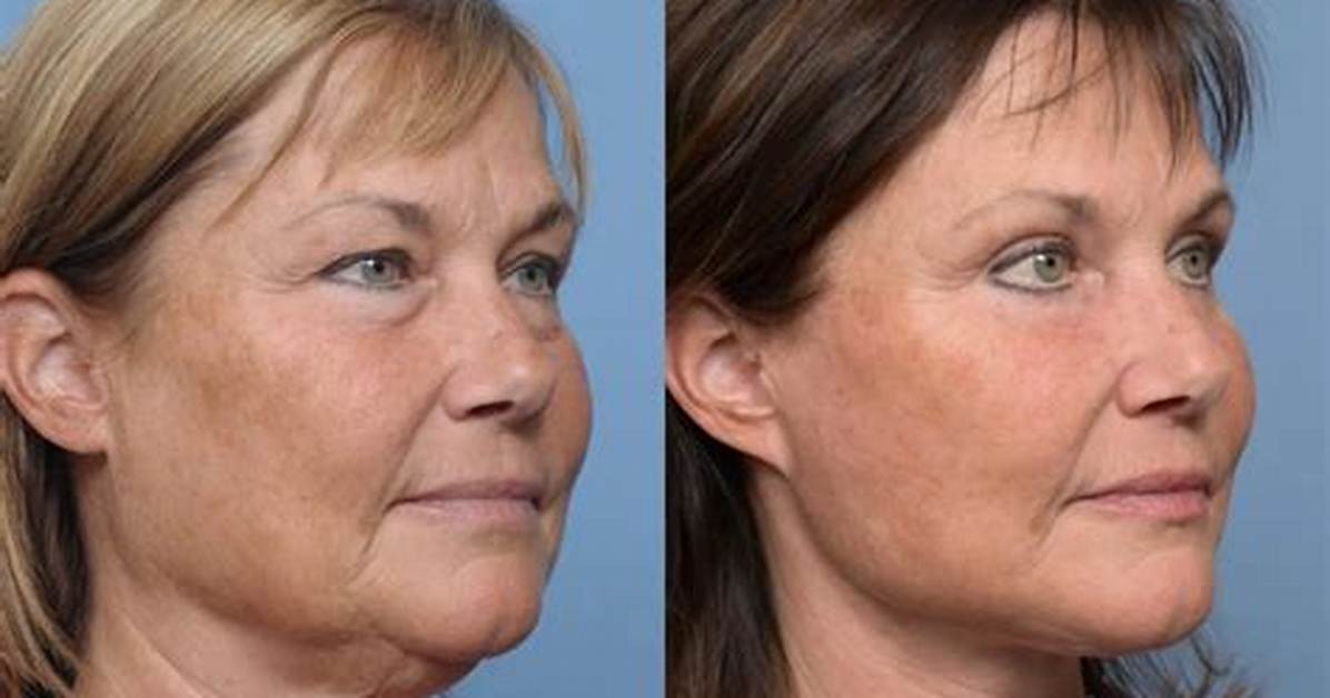 Susan Page's Facelift: Before and After Photos