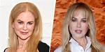 The Ultimate Guide to Nicole Kidman's Plastic Surgery Journey