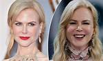 Why Nicole Kidman's Fillers Are the Talk of the Town